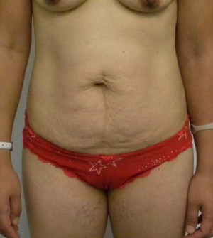 Tummy tuck (Abdominoplasty)