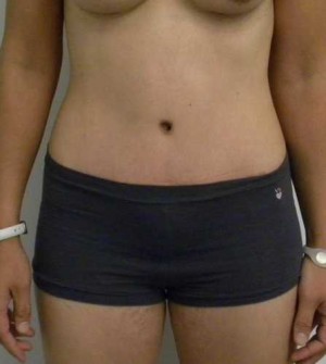 Tummy tuck (Abdominoplasty)