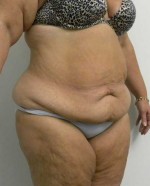 Tummy tuck (Abdominoplasty)