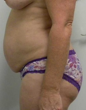 Tummy tuck (Abdominoplasty) Case 3976 Before Photo Tummy tuck (Abdominoplasty)