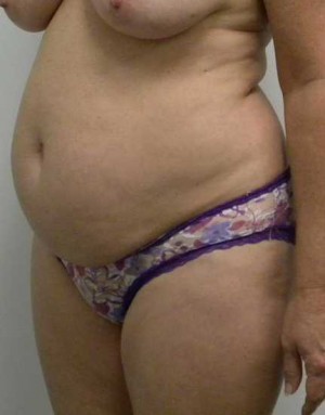 Tummy tuck (Abdominoplasty) Case 3976 Before Photo Tummy tuck (Abdominoplasty)