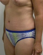 Tummy tuck (Abdominoplasty)