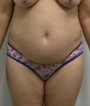 Tummy tuck (Abdominoplasty) Case 3976 Before Photo Tummy tuck (Abdominoplasty)