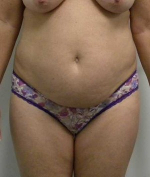 Tummy tuck (Abdominoplasty)