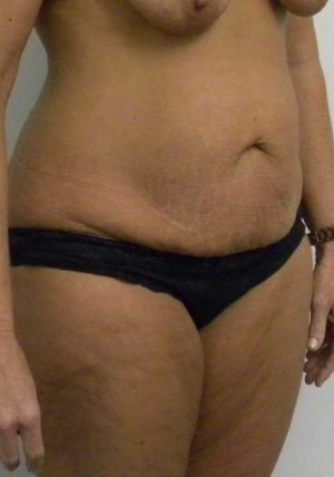 Tummy tuck (Abdominoplasty)