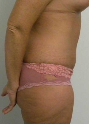 Tummy tuck (Abdominoplasty) Case 3983 After Photo Tummy tuck (Abdominoplasty)