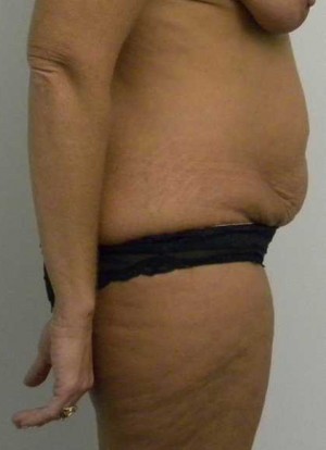 Tummy tuck (Abdominoplasty)