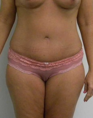 Tummy tuck (Abdominoplasty)