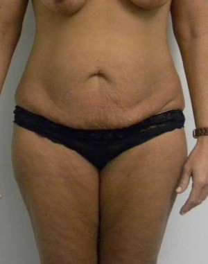 Tummy tuck (Abdominoplasty)