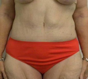 Tummy tuck (Abdominoplasty)