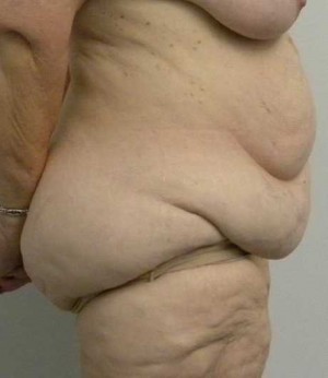 Tummy tuck (Abdominoplasty) Case 3990 Before Photo Tummy tuck (Abdominoplasty)