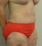 Tummy tuck (Abdominoplasty)