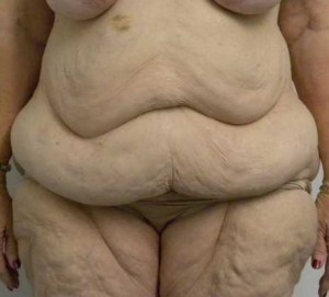 Tummy tuck (Abdominoplasty) Case 3990 Before Photo Tummy tuck (Abdominoplasty)