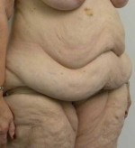 Tummy tuck (Abdominoplasty)