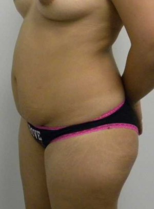 Tummy tuck (Abdominoplasty)