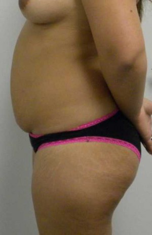 Tummy tuck (Abdominoplasty)