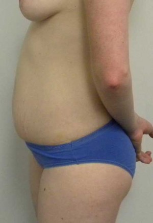 Tummy tuck (Abdominoplasty) Case 4011 Before Photo Tummy tuck (Abdominoplasty)