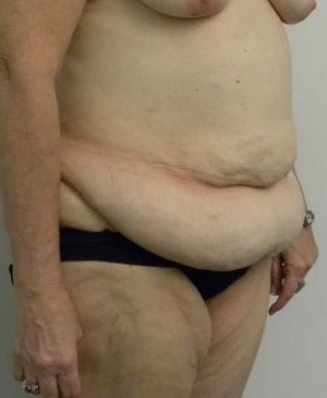 Tummy tuck (Abdominoplasty) Case 4018 Before Photo Tummy tuck (Abdominoplasty)