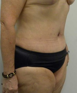 Tummy tuck (Abdominoplasty)