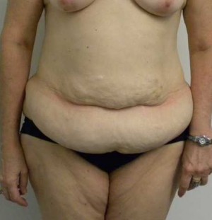 Tummy tuck (Abdominoplasty)