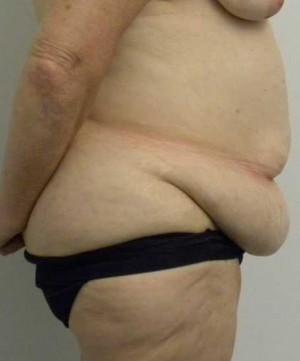 Tummy tuck (Abdominoplasty) Case 4018 Before Photo Tummy tuck (Abdominoplasty)