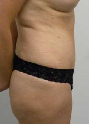 Tummy tuck (Abdominoplasty)