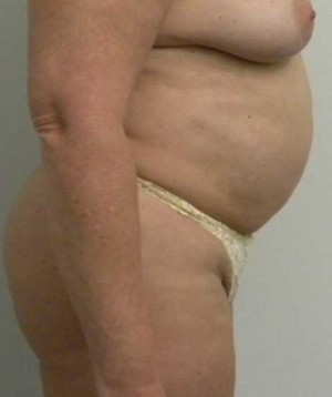 Tummy tuck (Abdominoplasty)