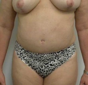 Tummy tuck (Abdominoplasty)