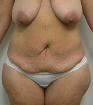 Tummy tuck (Abdominoplasty)