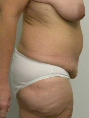 Tummy tuck (Abdominoplasty)