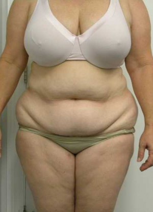 Tummy tuck (Abdominoplasty)