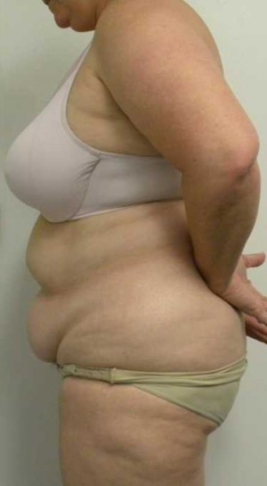 Tummy tuck (Abdominoplasty) Case 4053 Before Photo Tummy tuck (Abdominoplasty)