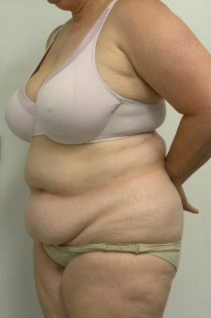 Tummy tuck (Abdominoplasty) Case 4053 Before Photo Tummy tuck (Abdominoplasty)