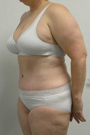 Tummy tuck (Abdominoplasty) Case 4053 After Photo Tummy tuck (Abdominoplasty)