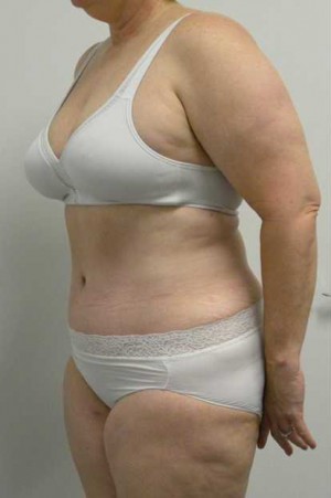 Tummy tuck (Abdominoplasty)