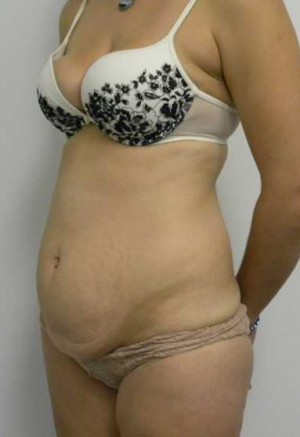 Tummy tuck (Abdominoplasty)