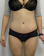 Tummy tuck (Abdominoplasty)
