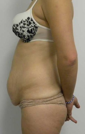 Tummy tuck (Abdominoplasty)