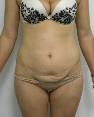 Tummy tuck (Abdominoplasty)