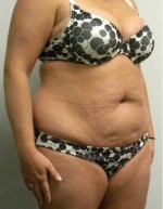 Tummy tuck (Abdominoplasty)