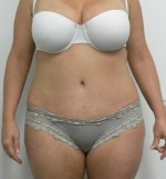 Tummy tuck (Abdominoplasty)
