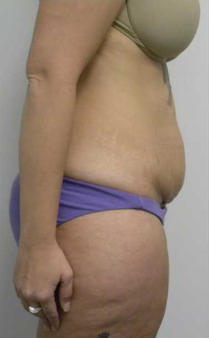 Tummy tuck (Abdominoplasty)