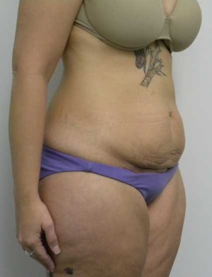 Tummy tuck (Abdominoplasty)