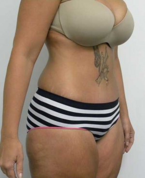 Tummy tuck (Abdominoplasty)