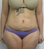 Tummy tuck (Abdominoplasty)