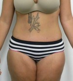 Tummy tuck (Abdominoplasty)