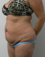 Tummy tuck (Abdominoplasty)