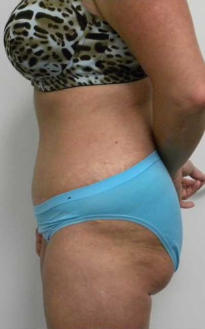 Tummy tuck (Abdominoplasty)