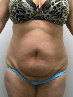 Tummy tuck (Abdominoplasty)