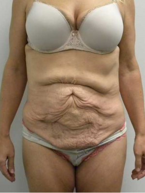 Tummy tuck (Abdominoplasty)